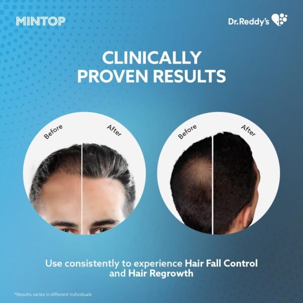 Dr. Reddy’s Mintop Forte 10% Minoxidil – 60ml