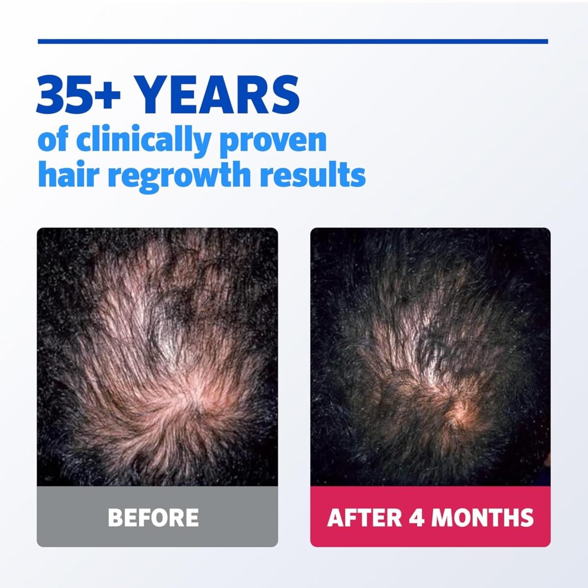 Men's Rogaine 5% Minoxidil Liquid - 3Month Supply - Image 4