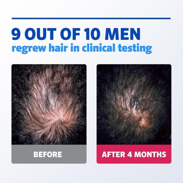 Men’s Rogaine 5% Minoxidil Topical Foam - 60gm Intact Box - Image 3