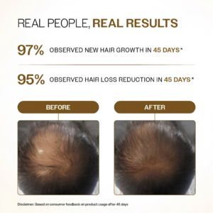 Bare Anatomy Advanced Hair Growth Serum Roll-On 25ml bottle showing premium built-in massage tip hair care packaging layout