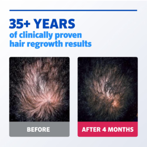 Rogaine, Minoxidil 5%, Hair Regrowth, Hair Loss Treatment, Men's Hair Solution, Extra Strength Minoxidil, Thinning Hair, Vertex Treatment, Dermatologist Recommended, White Cloud